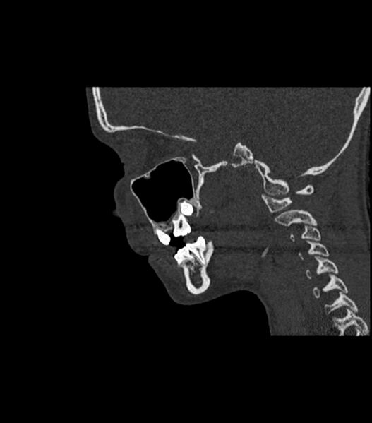 File:Nasoorbitoethmoid fracture (Radiopaedia 90044-107205 Sagittal bone window 57).jpg