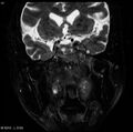 Nasopharyngeal carcinoma (Radiopaedia 4546-6667 Coronal T2 5).jpg