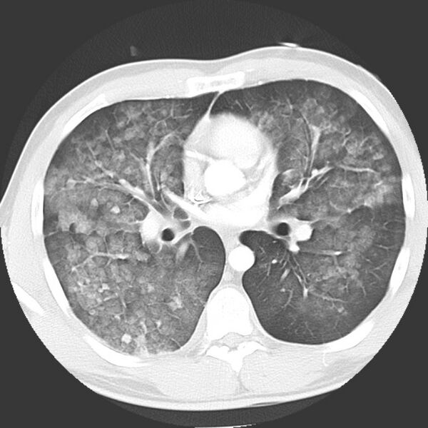 File:Near drowning pulmonary edema (Radiopaedia 16868-16591 Axial lung window 24).jpg