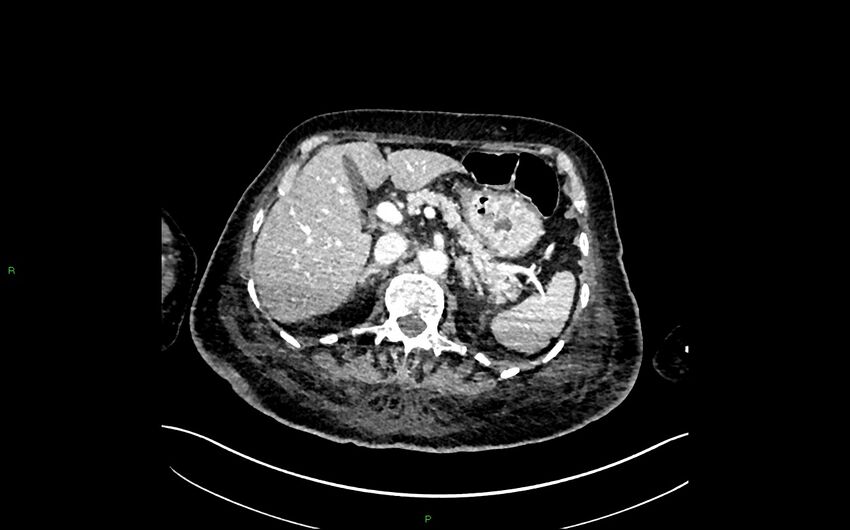 Neo-terminal ileal stricture (Crohn disease) (Radiopaedia 33790-34948 A 122).jpg
