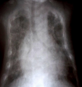 Chest X-ray: Diffuse interstitial syndrome in both lungs
