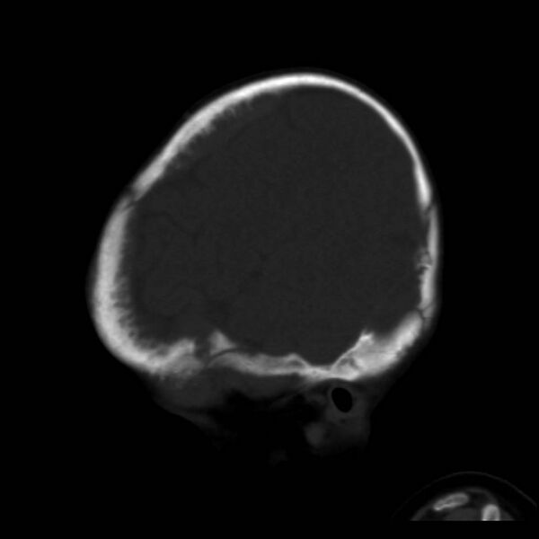 File:Neuroblastoma with skull metastases (Radiopaedia 30326-30958 Sagittal bone window 36).jpg