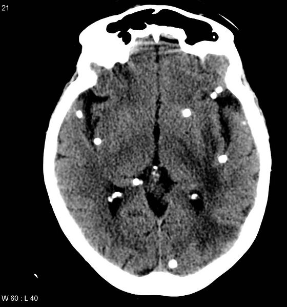 File:Neurocysticercosis (Radiopaedia 7773-8596 non-contrast 5).jpg