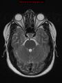 Neuroglial cyst (Radiopaedia 10713-11184 Axial T2 16).jpg