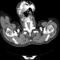 Non Hodgkin lymphoma in a patient with ankylosing spondylitis (Radiopaedia 84323-99624 B 1).jpg