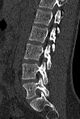 Normal CT lumbar spine (Radiopaedia 53981-60118 Sagittal bone window 61).jpg