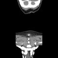Normal CT of the neck (Radiopaedia 14575-14500 Coronal C+ 51).jpg