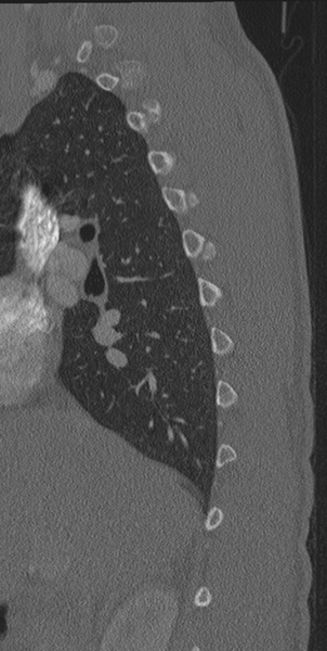 File:Normal CT thoracic spine (Radiopaedia 40181-42688 Sagittal bone window 55).png