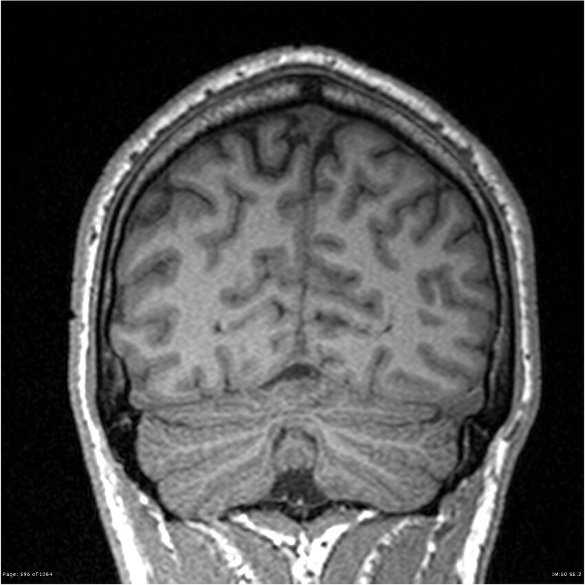 Normal brain MRI (non-focal epilepsy protocol) (Radiopaedia 38571-40700 Coronal T1 24).jpg