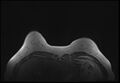 Normal breast MRI - dense breasts (Radiopaedia 80454-93850 Axial T1 33).jpg