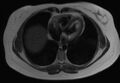 Normal liver MRI with Gadolinium (Radiopaedia 58913-66163 Axial T2 32).jpg