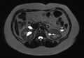 Normal liver MRI with Gadolinium (Radiopaedia 58913-66163 E 13).jpg
