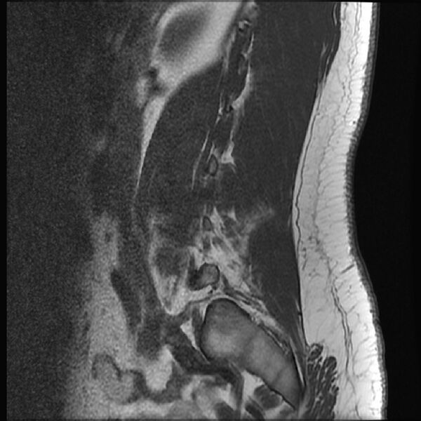 File:Normal lumbar spine MRI (Radiopaedia 43051-46311 Sagittal T1 18).jpg