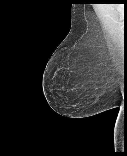 File:Normal mammography (low density breasts) (Radiopaedia 77169-89175 MLO 1).jpg