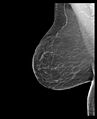 Normal mammography (low density breasts) (Radiopaedia 77169-89175 MLO 1).jpg