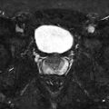 Normal prostate (MRI) (Radiopaedia 29986-30535 Axial STIR 10).jpg
