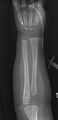 Normal skeletal survey - 5-month-old (Radiopaedia 53220-59186 E 1).jpg