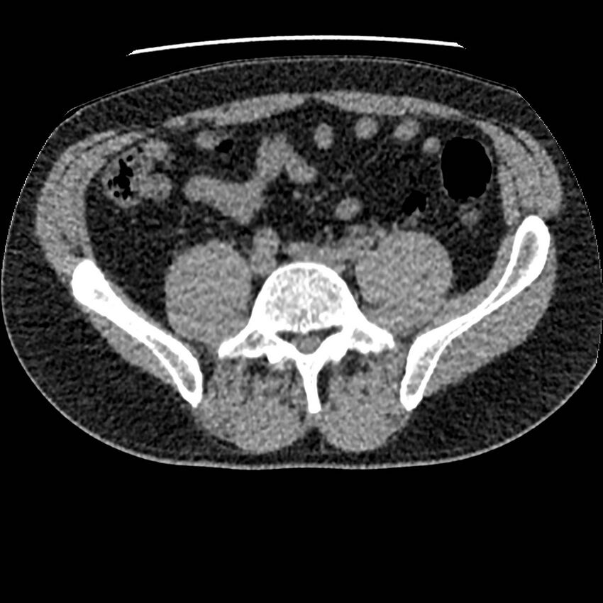 Obstructing ureteric calculus and ureteric anatomy (Radiopaedia 62730-71042 Axial non-contrast 100).jpg