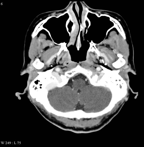 File:Occipital condyle metastasis - into mastoid (Radiopaedia 5424-7177 B 6).jpg