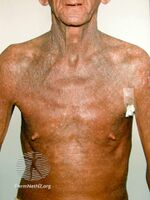 Sézary syndrome (DermNet NZ dermal-infiltrative-sezary-1).jpg