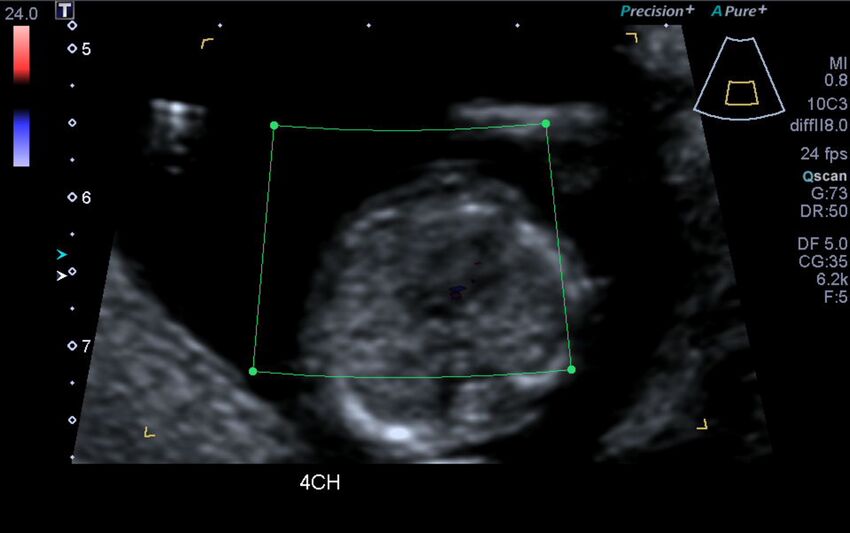 1st trimester nuchal-morphology ultrasound (Radiopaedia 44706-48477 Heart views cine with colour 64).jpg