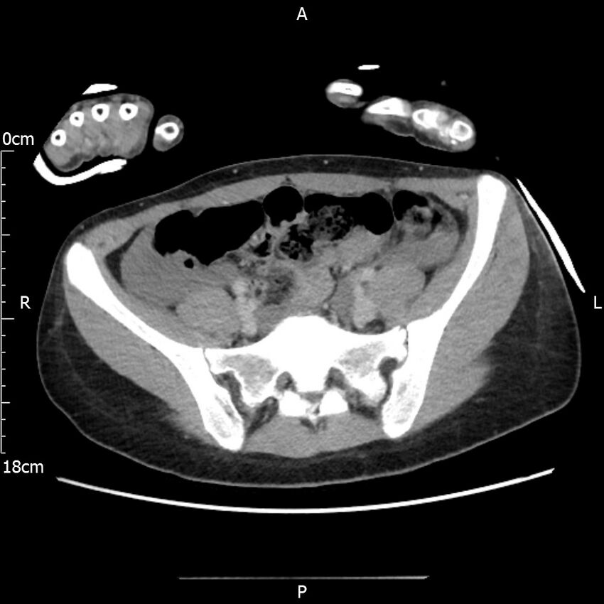 AAST grade IV kidney injury with CEUS follow-up (Radiopaedia 72353-82877 Axial C+ portal venous phase 55).jpg