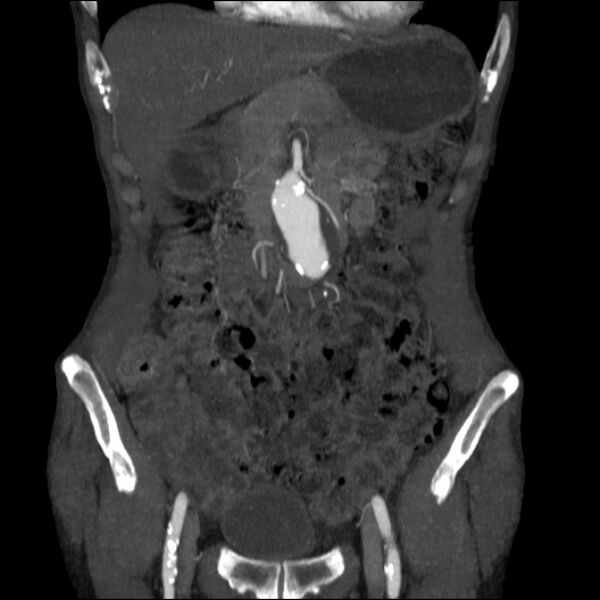 File:Abdominal aortic aneurysm (Radiopaedia 23703-23856 Coronal C+ arterial phase 5).jpg
