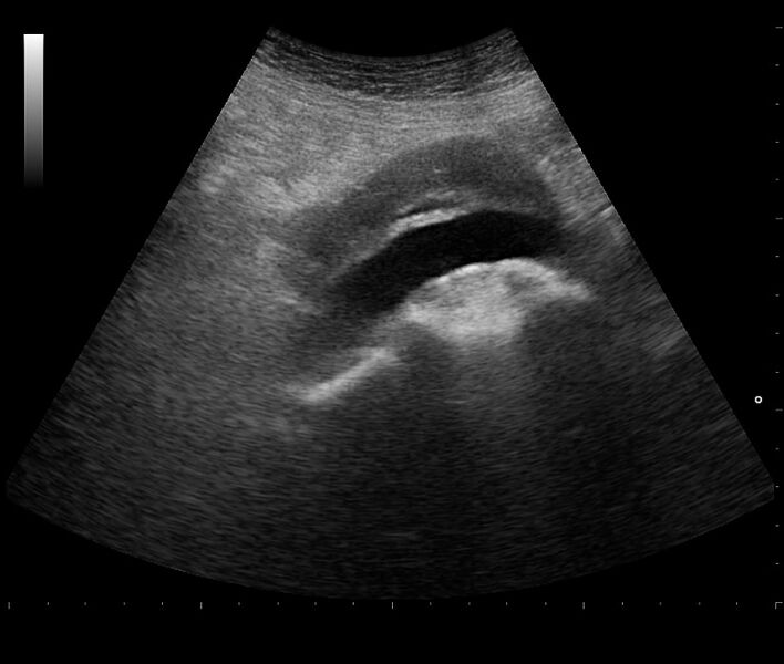 File:Abdominal aortic aneurysm (Radiopaedia 34563-35938 A 1).jpg
