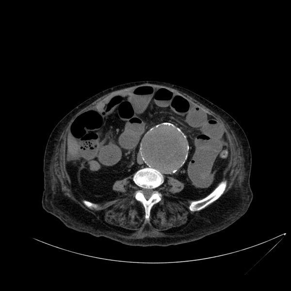 File:Abdominal aortic aneurysm - impending rupture (Radiopaedia 19233-19246 Axial non-contrast 76).jpg
