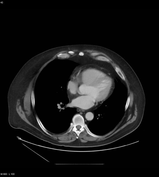 File:Abdominal aortic aneurysm with intramural hematoma then rupture (Radiopaedia 50278-55631 Axial C+ arterial phase 34).jpg