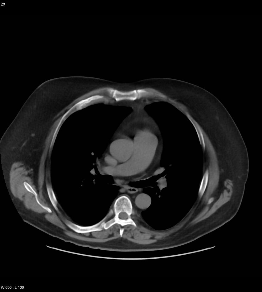 Abdominal aortic aneurysm with intramural hematoma then rupture (Radiopaedia 50278-55631 Axial non-contrast 24).jpg