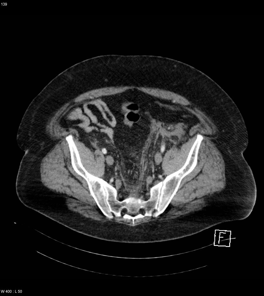 Abdominal aortic aneurysm with intramural hematoma then rupture (Radiopaedia 50278-55632 Axial C+ arterial phase 138).jpg