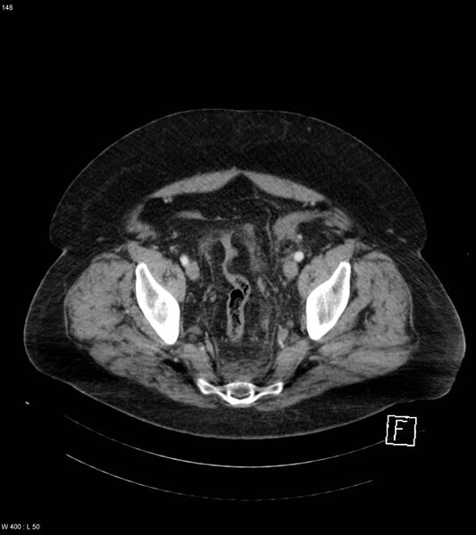 File:Abdominal aortic aneurysm with intramural hematoma then rupture (Radiopaedia 50278-55632 Axial C+ arterial phase 147).jpg