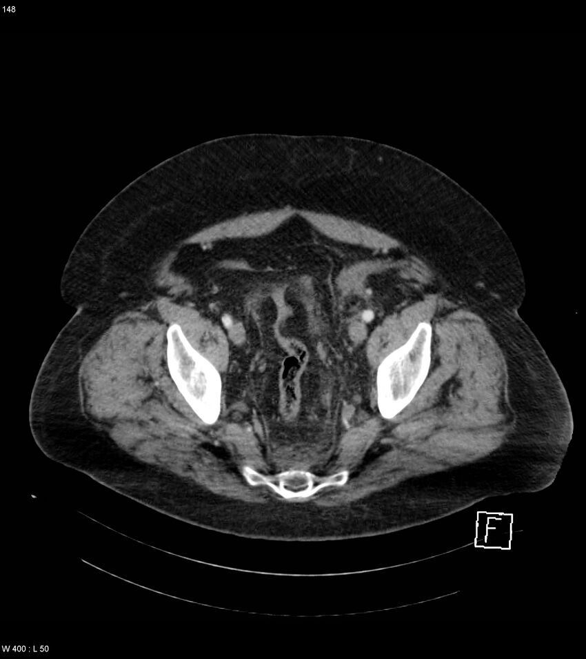 Abdominal aortic aneurysm with intramural hematoma then rupture (Radiopaedia 50278-55632 Axial C+ arterial phase 147).jpg