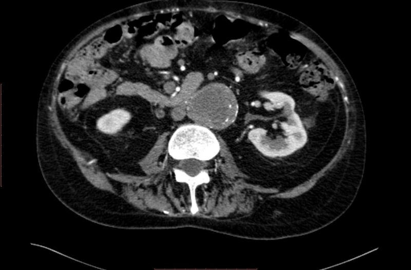 File:Abdominal aortic interposition tube graft and aneurysm thrombosis (Radiopaedia 71438-81857 Axial C+ arterial phase 76).jpg
