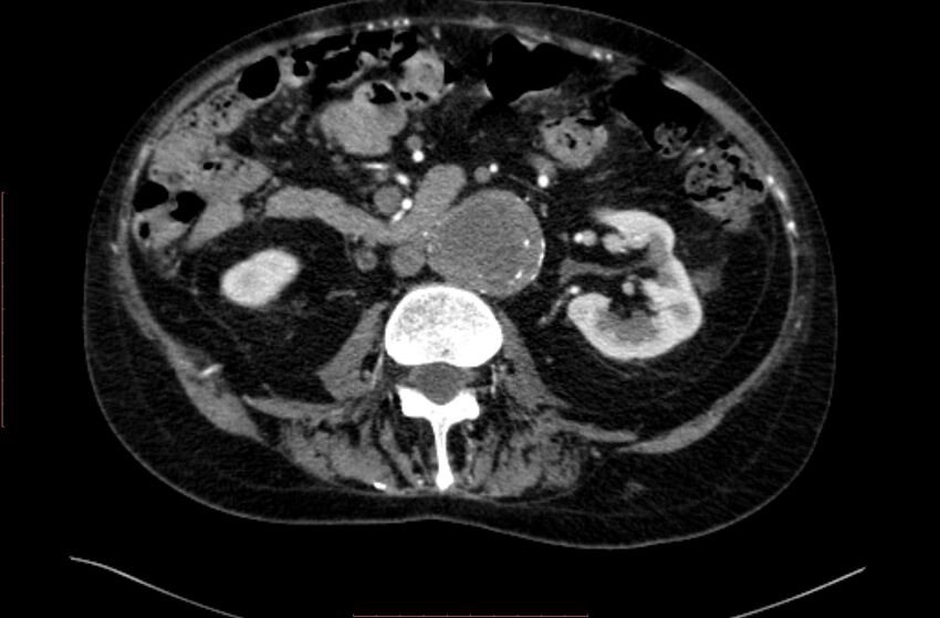 Abdominal aortic interposition tube graft and aneurysm thrombosis (Radiopaedia 71438-81857 Axial C+ arterial phase 76).jpg