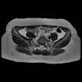 Abdominal wall endometriosis (Radiopaedia 83702-98847 Axial T2 2).jpg
