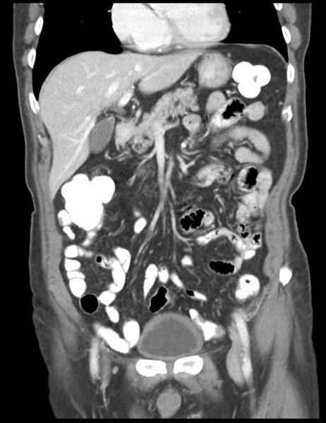 File:Abdominal wall metastasis from colorectal carcinoma (Radiopaedia 31016-31717 Coronal C+ portal venous phase 18).jpg
