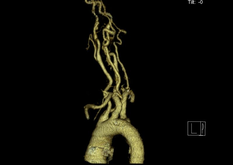 File:Aberrant right subclavian artery (Radiopaedia 19283-19294 3D reconstruction C+ arterial phase 16).jpg
