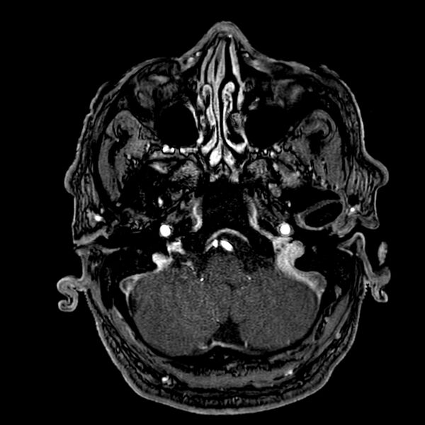 File:Accessory middle cerebral artery (Radiopaedia 73114-83828 Axial MRA 20).jpg