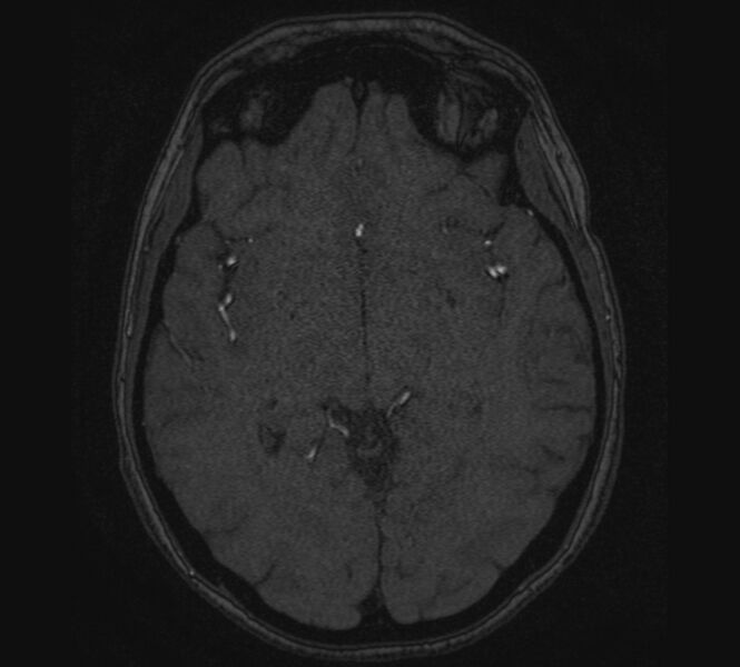 File:Accessory middle cerebral artery and ICA aneurysm (Radiopaedia 22656-22674 MRA 67).jpg