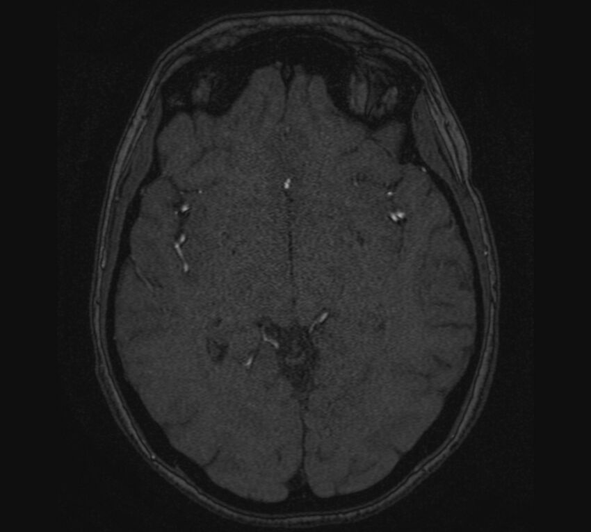 Accessory middle cerebral artery and ICA aneurysm (Radiopaedia 22656-22674 MRA 67).jpg