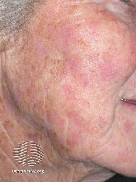 File:Actinic Keratoses treated with imiquimod (DermNet NZ lesions-ak-imiquimod-3770).jpg