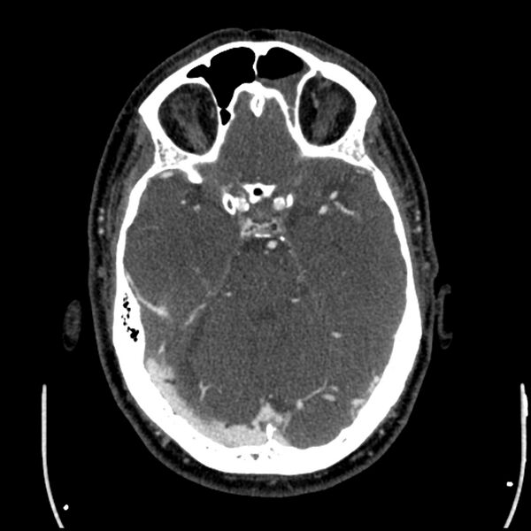 File:Acute A3 occlusion with ACA ischemic penumbra (CT perfusion) (Radiopaedia 72036-82527 Axial C+ arterial phase thins 116).jpg