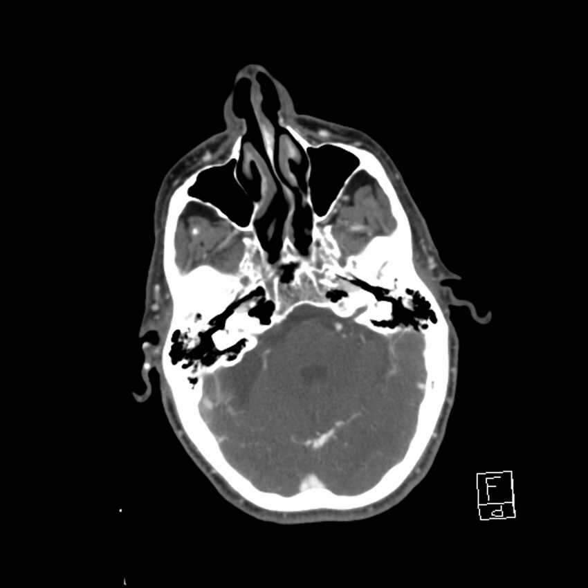 Acute ICA ischemic penumbra due to high-grade CCA stenosis (CT perfusion) (Radiopaedia 72038-82530 Axial C+ arterial phase 16).jpg