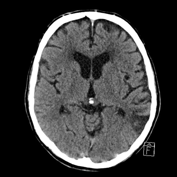 File:Acute P1 occlusion with PCA ischemia penumbra (CT perfusion) (Radiopaedia 72084-82586 Axial non-contrast 21).jpg