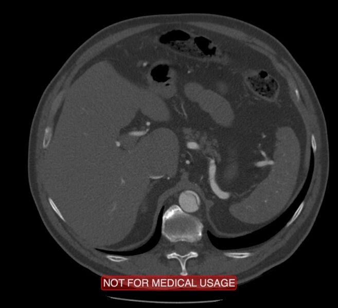 File:Acute aortic dissection - Stanford type A (Radiopaedia 40661-43285 Axial C+ arterial phase 81).jpg
