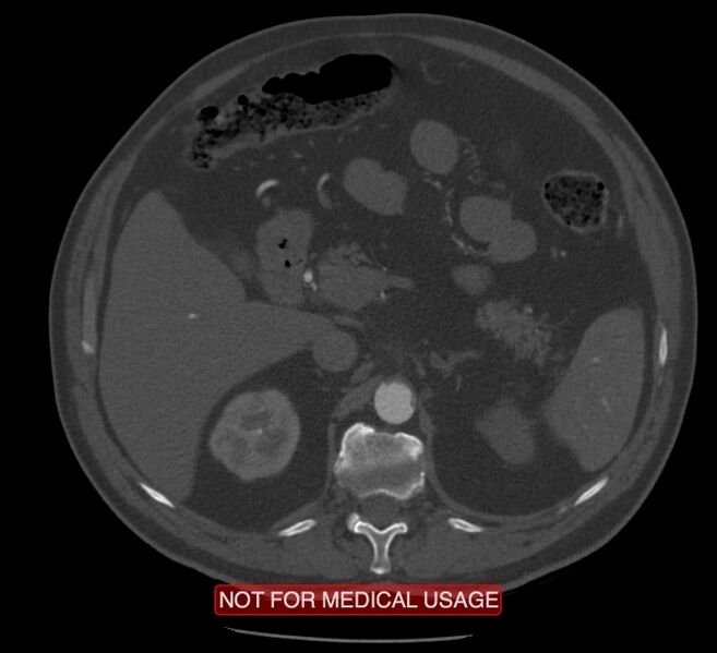 File:Acute aortic dissection - Stanford type A (Radiopaedia 40661-43285 Axial C+ arterial phase 94).jpg