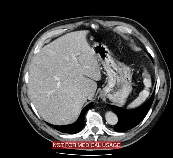 File:Acute aortic dissection - Stanford type A (Radiopaedia 40661-43285 Axial C+ portal venous phase 60).jpg