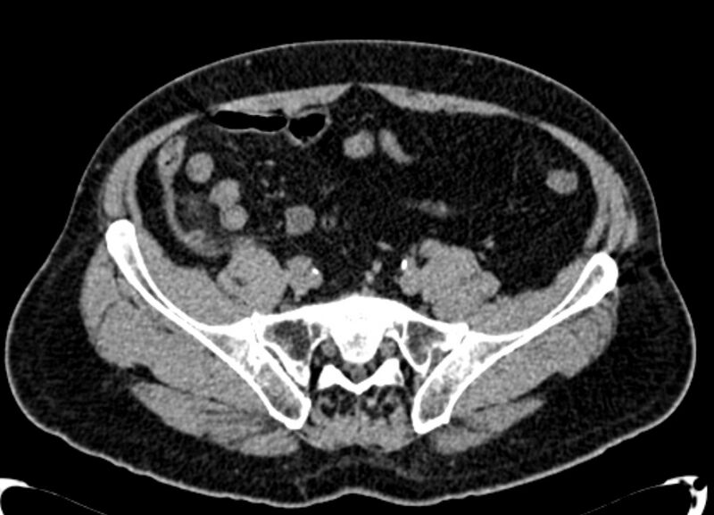 File:Acute appendicitis (Radiopaedia 13030-13091 Axial non-contrast 35).jpg